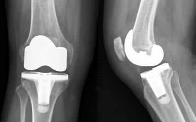 Total Knee Replacement and Pre-Operative Preparation
